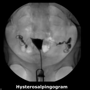 hsg hysterosalpingogram afct testing texas